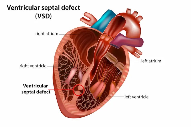 Understanding Ventricular Septal Defect and Management